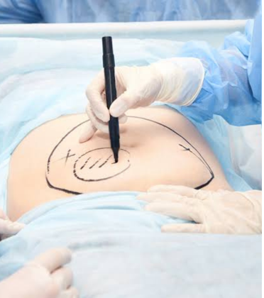 Colorectal Cancer Surgery by Dr. Arun Prasad